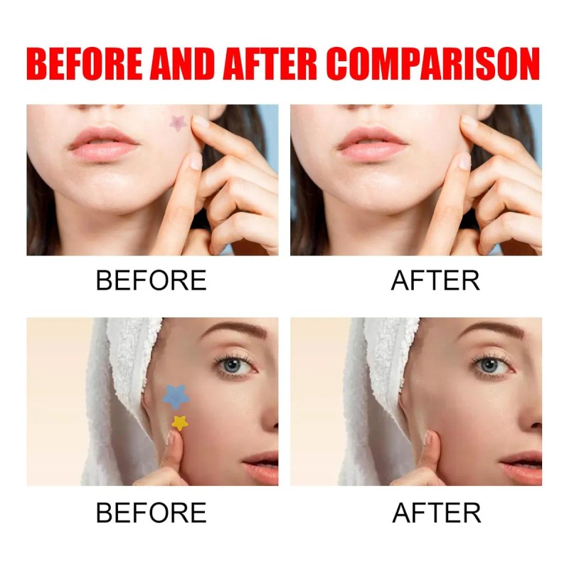 🔥 240pzs mascarillas parches para el acne espinillas granos Vitaminas