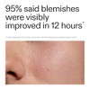 The INKEY List Succinic Acid Treatment 15ml
