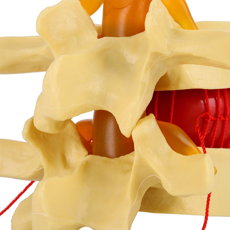 1:1.5 Anatomical Medical Human Spine Lumbar Disc Herniation Demonstration Model