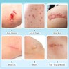 Hydrocolloid Roll for Wound Care - Medical Grade Hydrocolloid Bandages