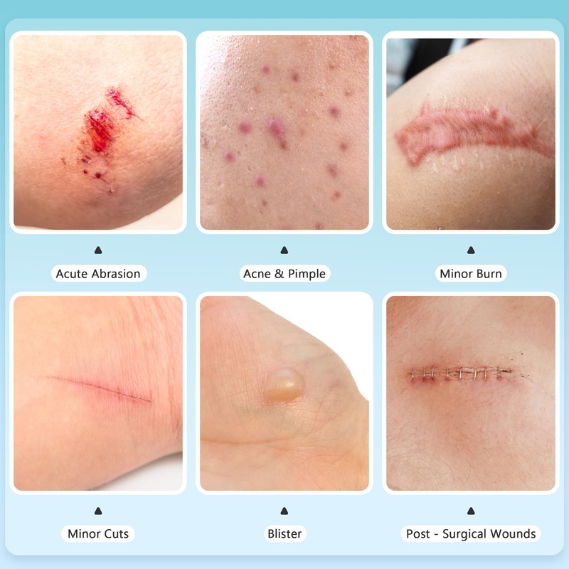 Hydrocolloid Roll for Wound Care - Medical Grade Hydrocolloid Bandages