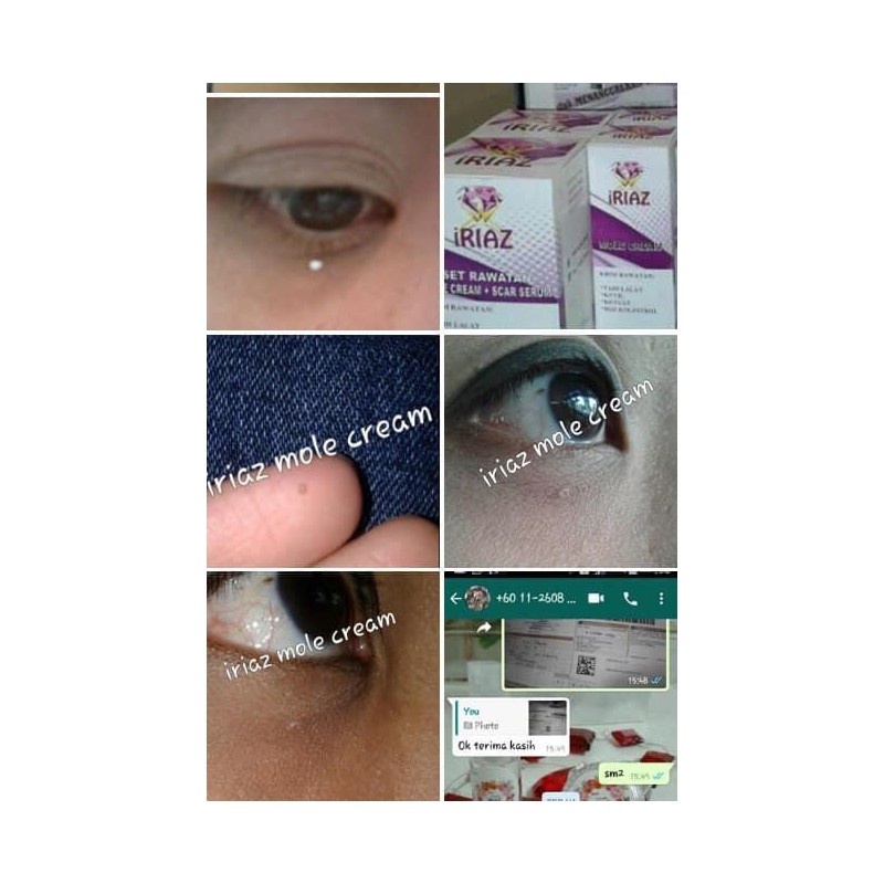 IRIAZ MOLE CREAM BUANG TAHI LALAT KUTIL BIJI KOLESTEROL