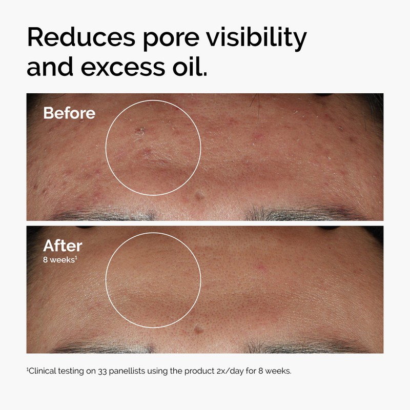 The Ordinary Niacinamide 10% + Zinc 1%, Smoothing Serum for