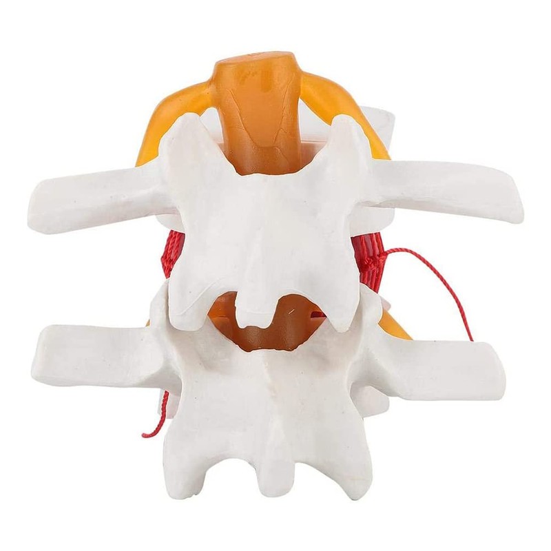 TOBEOME 1:1.5 Human Demonstration Model for Herniated Disc of the