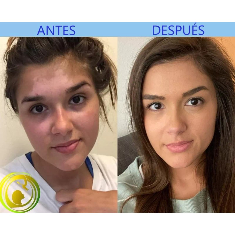 Cenit Crema Alba, Para Piel Con Vitíligo