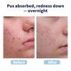Large Pimple Patches for Face，9 Sizes XL Acne Patches，Big Hydrocolloid