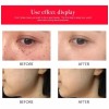 Cauterizador Quita Manchas Pecas Verrugas Tatuajes Con Luces