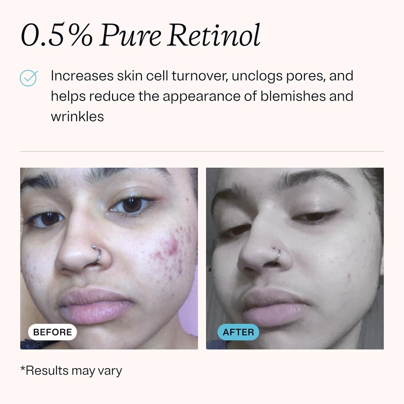 MDacne – Retinol 0.5% and Niacinamide 4% Cream, Reduces Blemishes