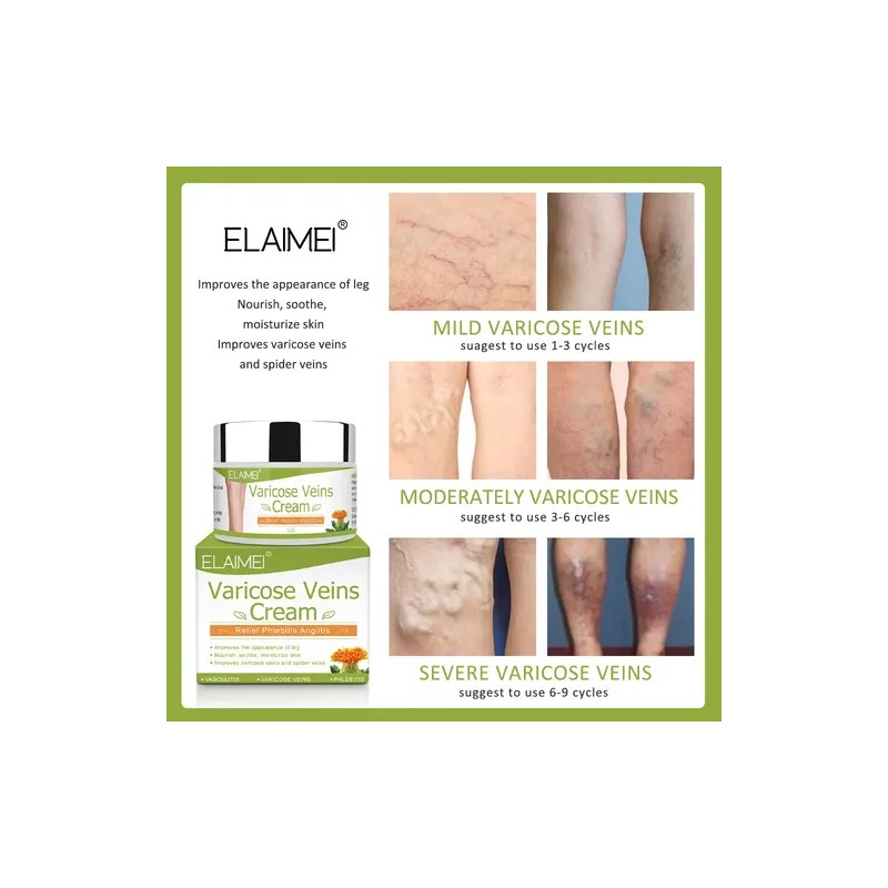 Crema Varices Mejor Apariencia De Tus Piernas Alivia Dolor