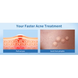 Chic Glamour Emporium Patch - Hydrocolloid Acne Pimple Patch for Covering Zits and Blemishes, Spot Stickers for Face and Skin (72 Count)