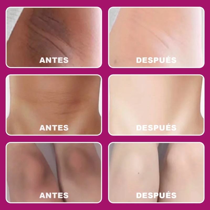 Aceite Acantosis Nigricans, Mejora La Hiperpigmentac Neutra