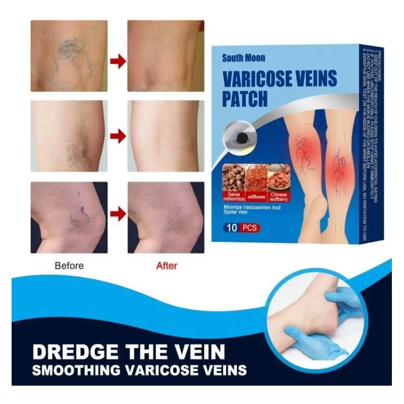 Parche De Tratamiento De Venas Varicosas 30 Piezas