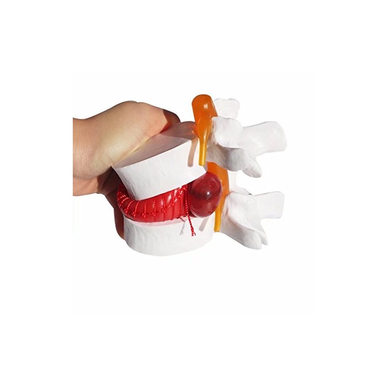 BoNew 1:1.5 Anatomical Human Lumbar Vertebrae Degenerative Lumbar Human Spine