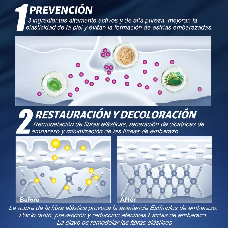 Crema Para Estrías En Embarazo Eliminar Las Líneas De Embara