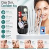 Herramientas de eliminación de puntos negros, kit de herramientas para