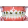 Snapcaps Braces Bumper Cover, Orthodontic Bracket Wax Substitute, Alternative Snap-on