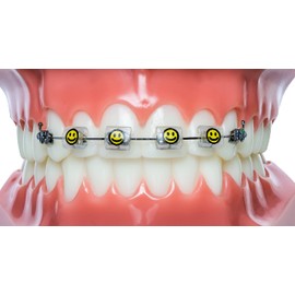 Snapcaps Braces Bumper Cover, Orthodontic Bracket Wax Substitute, Alternative Snap-on Braces Guard Braces Accessories 10 pack (Smiley Face)