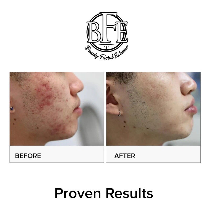 Tratamiento Del Acné, Almohadillas Para El Acné Que Contiene