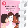 Large Acne Pimple Patches for Face & Body – 4 Sizes, XL Hydrocolloid Bandages for Forehead, Cheeks, Chin, Back, Chest & Butt