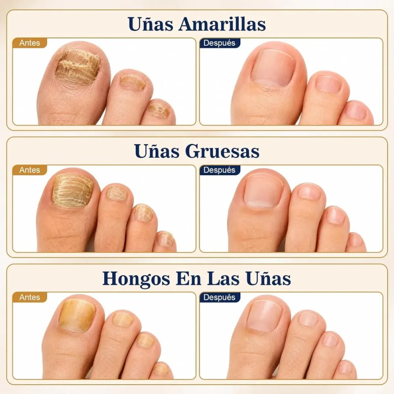 Crema Para El Cuidado De Las Uñas,pomada Reparadora De Uñas