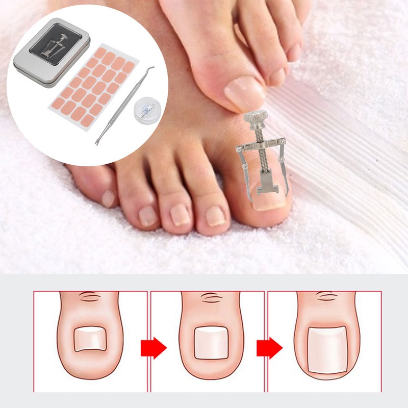 Ingrown Toenail Correction Patch Ingrown Nail Corrector Nail Insert Buckle