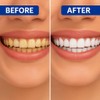 5D Advanced Teeth Whitening Strips Kit – 28 Pcs for