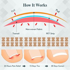 Yuerme Ingrown Toenail Treatment, 81PCS Ingrown Toenail Kit for Toenail Care, Includes 80 PCS Ingrown Toenail Corrector Patch, and 1 Styles Ingrown Toenail Tool