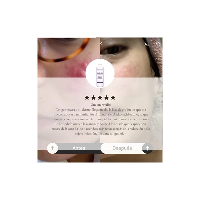 Kit Para Acné Hormonal Shampoo, Azelac Lotion, Gel Y Loción