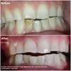 Crystal Clear Teeth Whitening Kit de Gel Blanqueador de Dientes