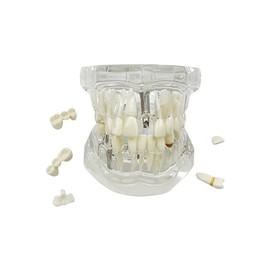 Modelo de implante de dientes, para enseñanza, modelo de enfermedad, estándar, extraíble, patología de YOUYA DENTAL