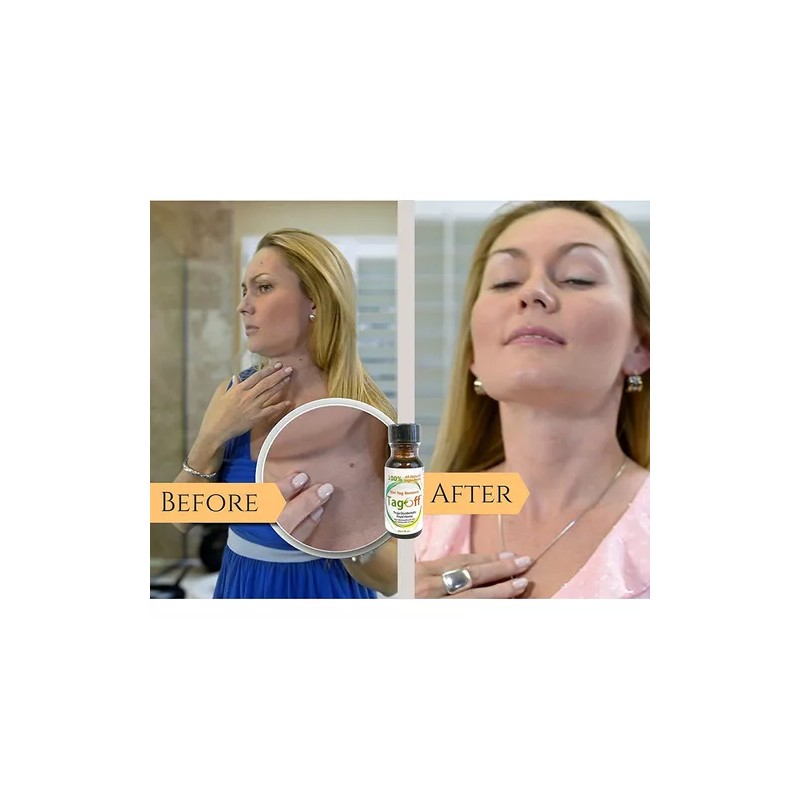 Tagoff Remueve Naturalmente Verrugas Sin Dolor Ni Cicatrices