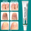 Crema Para Eliminar Hongos En Uñas De Manos , Pies