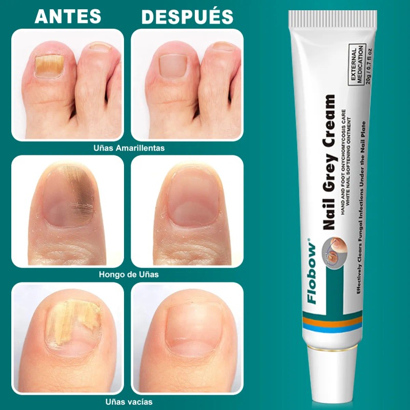 Crema Para Eliminar Hongos En Uñas De Manos , Pies
