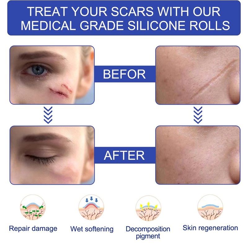 Self-adhesive Silicone Scar Patch 1.6x120 inches Transparent Invisible Scar Sheets