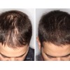 Tratamiento Anticaida Y Crecimiento De Cabello -hl Dermapen