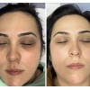 Crema Despigmentante De Paño Melasma Acne