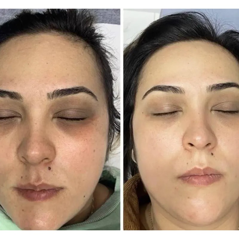 Crema Despigmentante De Paño Melasma Acne