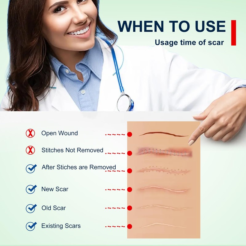 Silicone Scar Sheets (1.6” x 120” Roll-3M), Silicone Scar Tape