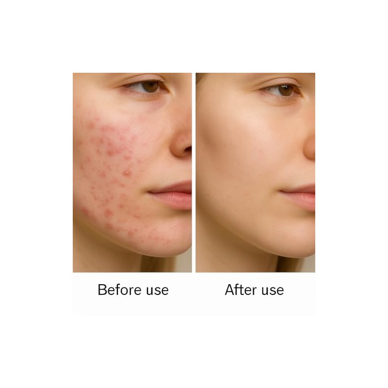 Golden Future Anti-Acne Revitalising Cream, Targeted Spot Treatment, Pimple Reducer