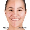 Kit Tratamiento Acné Lilo Skincare Té Verde Y Niacinamida