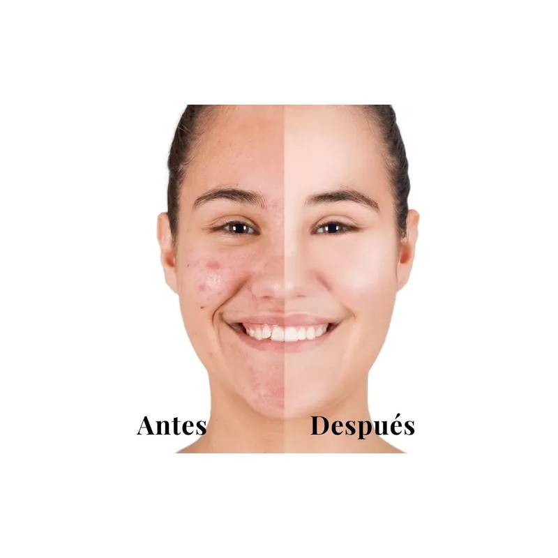 Kit Tratamiento Acné Lilo Skincare Té Verde Y Niacinamida