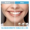 Kit Blanqueamiento Smile Limpieza Blanqueador Dental