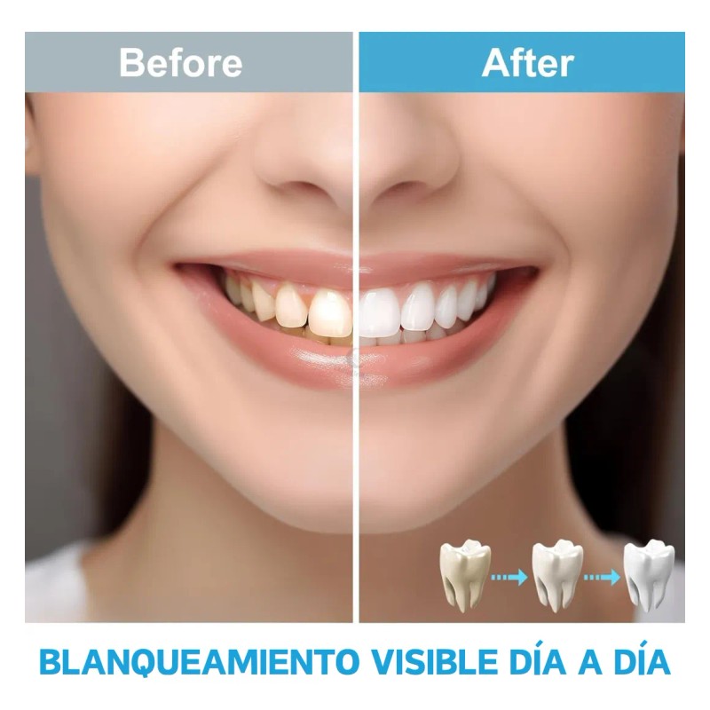 Kit Blanqueamiento Smile Limpieza Blanqueador Dental
