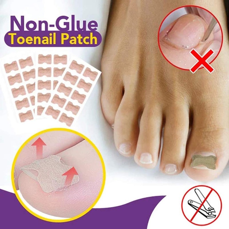 Ingrown Stickers, Corrector Pedicure Tools, Toenail Patch, Ingrown Toenails, Ingrown