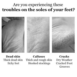 Foot File Callus Remover with Dead Skin Catcher, Foot Heel Scraper for Cracked Heel Treatment, Wet & Dry Use Feet Rasp, Foot Rasp Foot File and Callus Remover, Surgical Grade Stainless Steel File