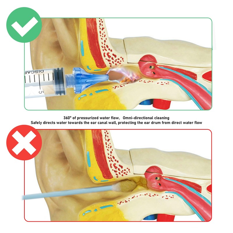 ETTSNU 20mL Ear Syringes for Removing Ear Wax, Cleaning Water