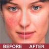 QUATRIDERM Fast Relief Hydrocortisone Cream for Eczema Itch Inflammation Aloe