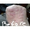 LichensEze 16 Oz All Natural Relief, For Lichen Planus No