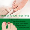 M Jaysuing Tratamiento Hongos De Uñas Herbal 30ml Neutra