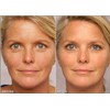 Retinol Gel 0.1 Vitamin A Repairs Fine Lines Wrinkles, Scar
